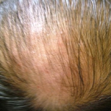 loss of hair