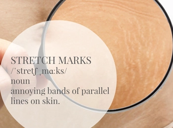 Stretch Marks What are they and the risks they pose