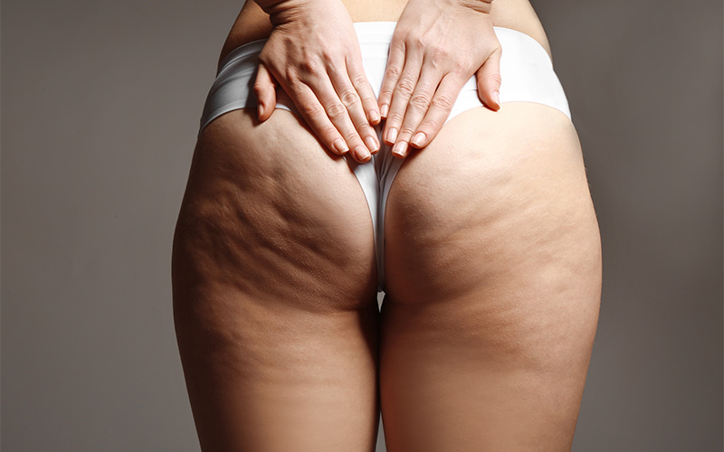 cellulite-on-thighs-and-buttocks